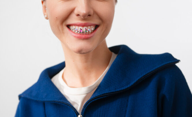 Czy aparat samoligaturujący prostuje wady zgryzu szybciej?