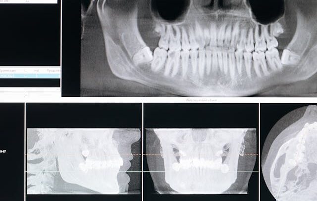 Jak często można wykonywać tomografię zębów?
